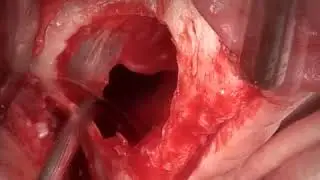 Sinus (Schneiderian Membrane) Membrane Repair Technique