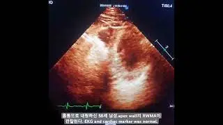 협심증으로 인한 흉통(unstable angina)