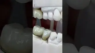 Custom implants ceramics!