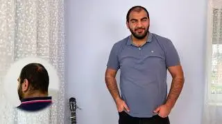 Haartransplantation Vorher Nachher | 11 Wochen Update