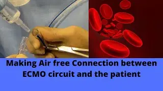 Making Air free Connection  between ECMO circuit  and the patient