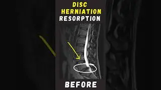 Lumbar Disc herniation reabsorbed #sciatica #sciaticapainrelief #discherniation