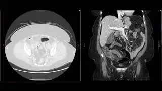 Abdominal Imaging Call Prep Cases: Perforated Appendicitis (CT) Case 1 Discussion