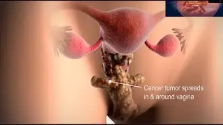 Cervical Cancer | Women Health Problems |