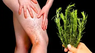 Incredible!🤩This is a varicose veins killer! Erases varicose veins like a rubber!