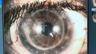 Scleral Lens Over A Transplanted Cornea With A Glaucoma Shunt