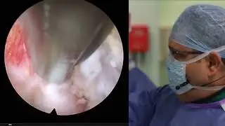Full-Endoscopic Decompression perfomred by N. Rath MD. Walton Centre Liverpool UK