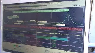 Чем Диамаг-2  круче Постоловского.