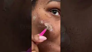 Pimple Patch Chronicles | I’m living in 🇧🇧 same acne #pimplepatch #omg