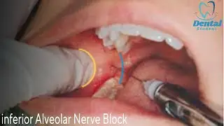 Inferior alveolar nerve block & Live demo بشرح مفصل