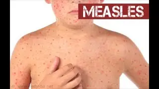 الحصبة أو (بوحمرون) Measles