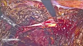 Ureteric re anastomosis