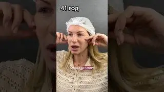 Как вам омоложение прекрасной пациентки? #fullface #омоложение #косметология