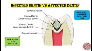 Infected Dentin Vs Affected Dentin