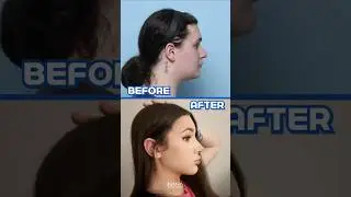 From Him to Her: Shocking FFS Before & After!