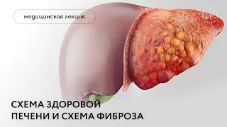 Схема здоровой печени и схема фиброза