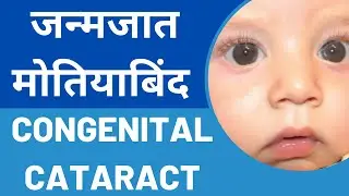 जन्मजात मोतियाबिंद (Congenital Cataract): बचाव और इलाज