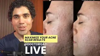 Dr. Qazi Unsponsored Live | Dr. Qazi Discusses How To Maximize your Acne Scar Results | 9.13.2024