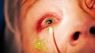 Hot girl removes over ten contact lenses from her eyes ! ! ! 👀🔍【Collection】
