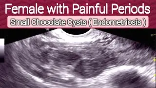 Small Ovarian Chocolate Cysts - Endometriosis | Infertility | Ultrasound