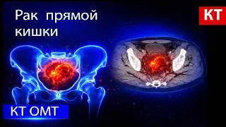 Рак прямой кишки на КТ