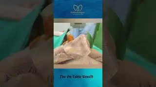 Watch this Nose Job Magic Happen!
