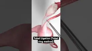 Elastic Birth Control (3D Animation)