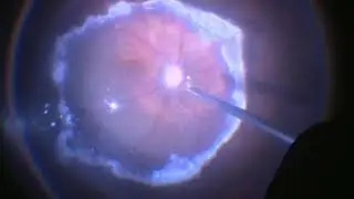 Surgery: Complex Retinal Detachment with PVR