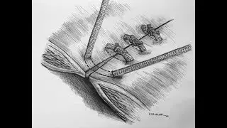 Mesh Sutured Repairs of Contaminated Incisional Hernias