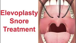 Elevoplasty Snore Treatment