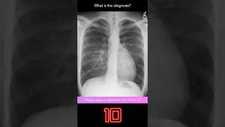 Chest X-ray Quiz 6 (explanation with overlays)