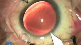 Tunnel Roof Tear Phaco 3.1 Complications
