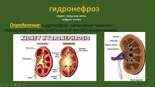 гидронефроз (определение, этиология и причины, патология, диагностика, клиника, виды, лечение)