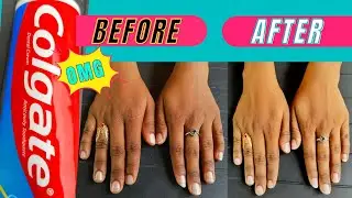 Skin whitening treatment with Colgate toothpaste || Tan removal home remedy / Beauty Hacks
