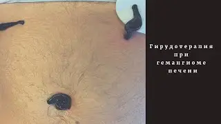 Гирудотерапия при гемангиоме печени