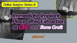 Immediate Implant Place after Extraction at #25 and Bond Graft
