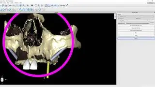 Guided Zygomatic Implants