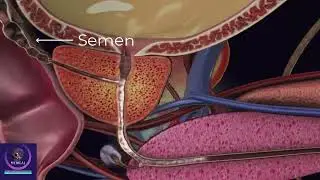 Prostate Gland 3D Animation | Formation of Cancer in Prostate Gland |