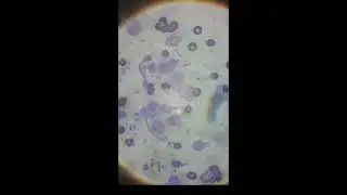 Лимфома под микроскопом