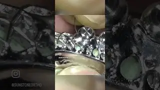 Here a locator frame is being welded directly on the model #ortho #ortholab