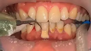 Transformacion de Sonrisa 😁 *ANTES & DESPUES*