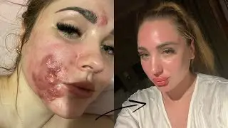 ACNE | What to do after a course of Roaccutane