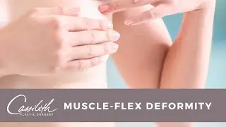Muscle Flex Deformity: A complication from breast augmentation explained by Dr. Lisa Cassileth