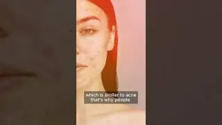 Does exposure to sun causes acne? | Dr. Afsheen  Bilal