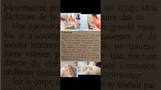 Contusion