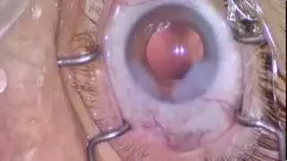 Cataract Surgery: Super Phaco Pearls Vol 2: Surgical Security