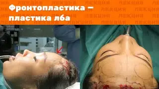 Лекция: Фронтопластика, пластика лба