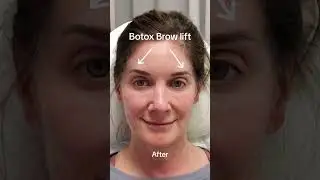 Botox Brow Lift #beowlift #botoxinjection