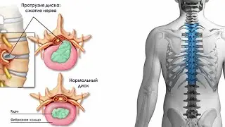 Мануальная терапия при протрузиях и межпозвонковых грыжах