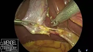 Laparoscopic cholecystectomy (unedited video 2x speed)